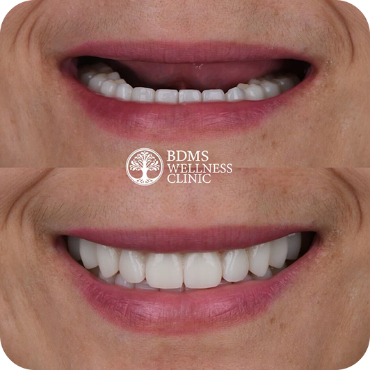 One-Day Crown Benefits