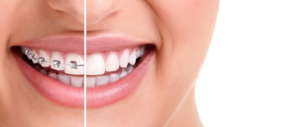 จัดฟันแบบใส invisalign ข้อดีอะไรบ้าง