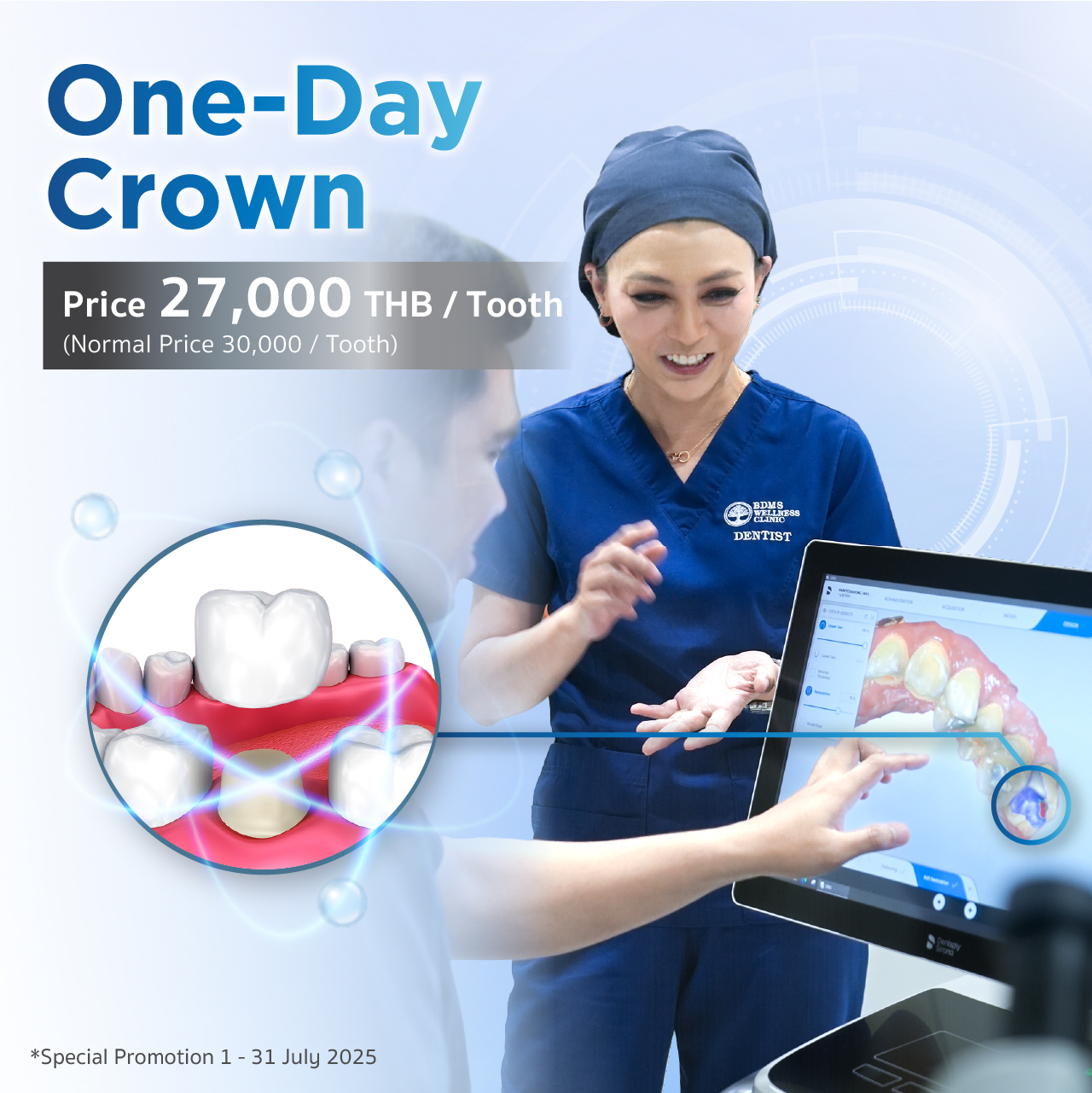 One-Day Crown ครอบฟันสวยในวันเดียวด้วยระบบดิจิทัล ราคาพิเศษ 27,000 บาท/ซี่ (จากปกติ 30,000 บาท) ในงาน Smile Upgrade Month BDMS Wellness Clinic ถนนวิทยุ โปรโมชั่นถึง 31 ก.ค.