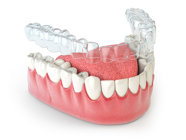  Is Invisalign Right for You?